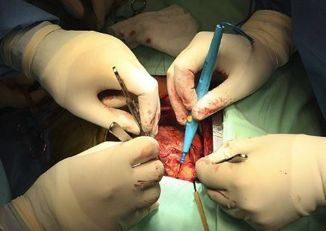 Впервые в Израиле: сердце больного достали из груди, чтобы   очистить от раковой опухоли